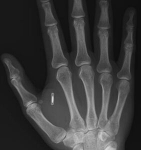 rfid-chip-implante
